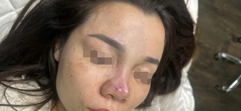 Biến chứng sau tiêm filler mũi. Ảnh minh họa
