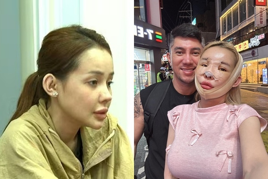 Ngân 98 hiện tại mặt biến dạng dù chi vài tỷ cho 12 lần phẫu thuật thẩm mỹ