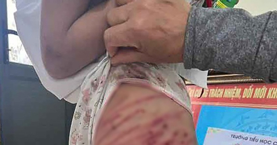 Hà Tĩnh: Xác minh vụ bé gái lớp 5 bị cha dượng bạo hành phải nhập viện