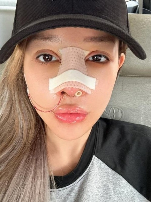 Lương Bằng Quang tiết lộ mũi Ngân 98 đang bị hoại tử