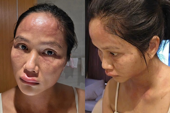 H'Hen Niê phát hoảng vì mặt sưng phù đến biến dạng, chuyện gì đây?