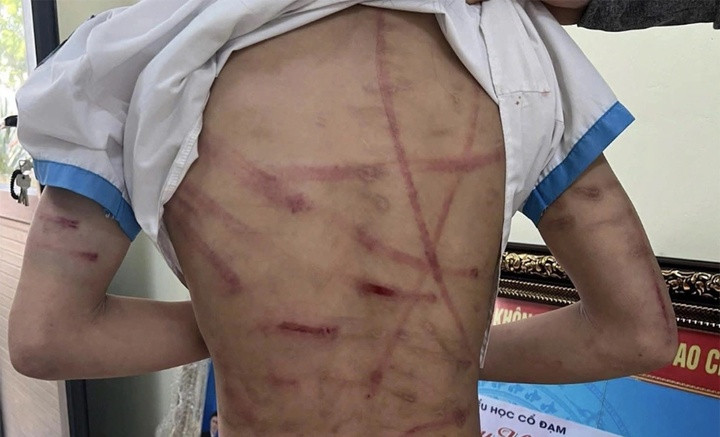 Vết thương trên người bé gái thời điểm bị cha dượng đánh.