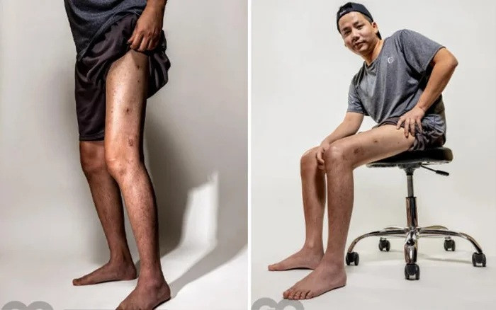 Clip bước đi tập tễnh di chuyển không vững sau khi chi tiền tỷ kéo chân gây sốc