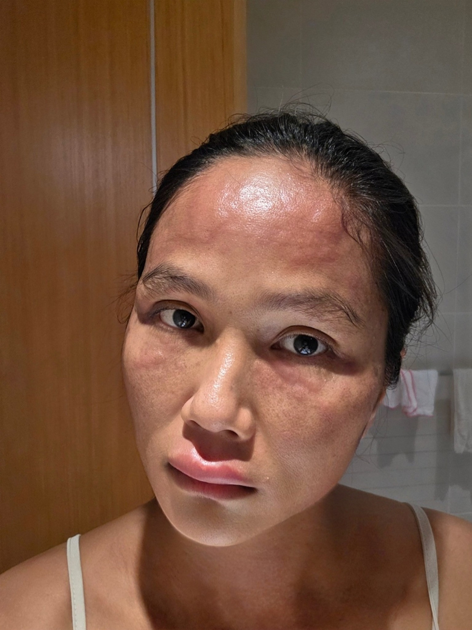 Tình trạng HHen Niê sau khi bị sưng phù mặt đến biến dạng