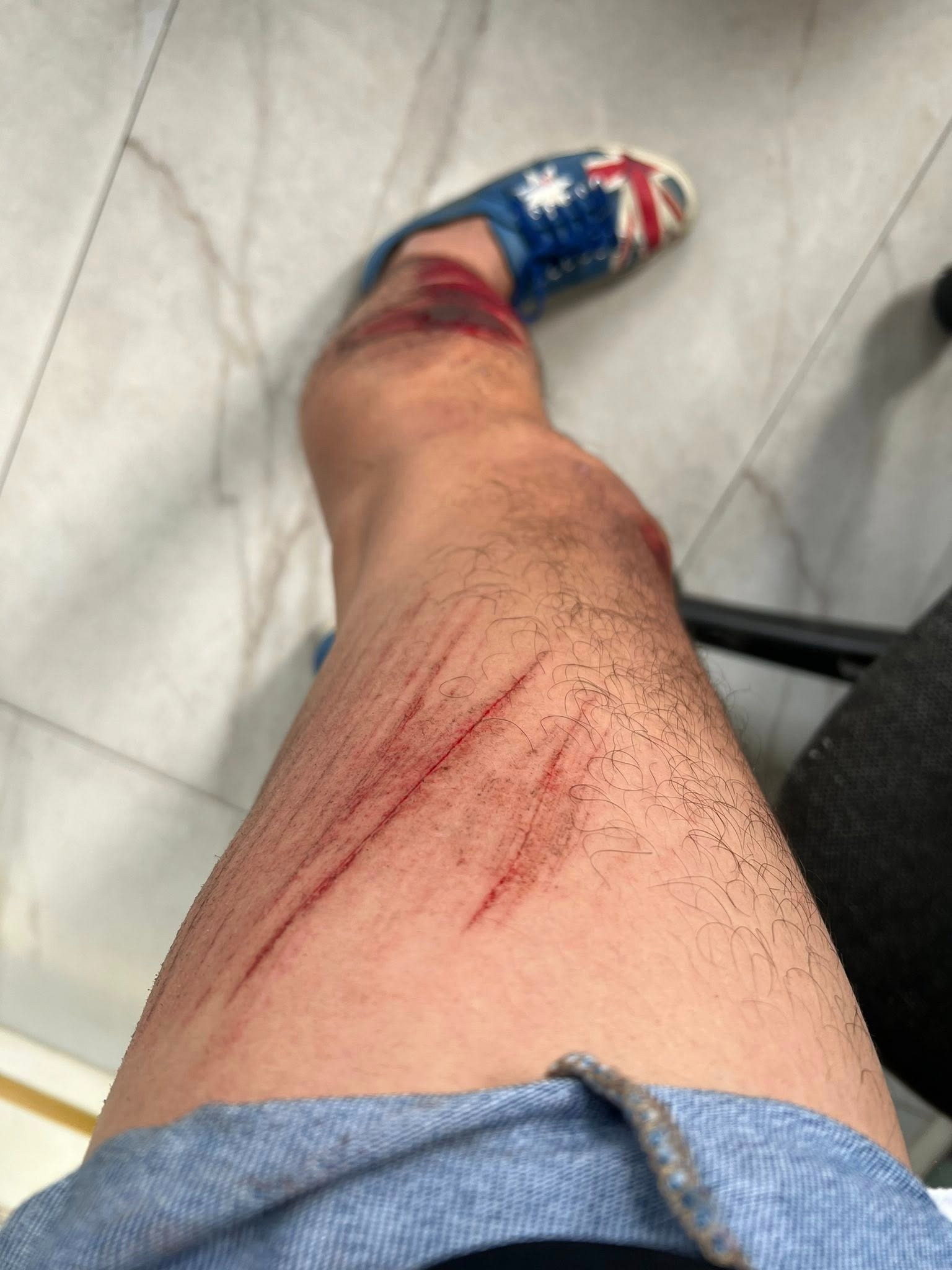 Nam diễn viên nổi tiếng Vbiz bị tai nạn kể lại khoảnh khắc kinh hoàng