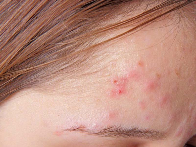 Tác hại của việc không dùng kem chống nắng - Ảnh 3.