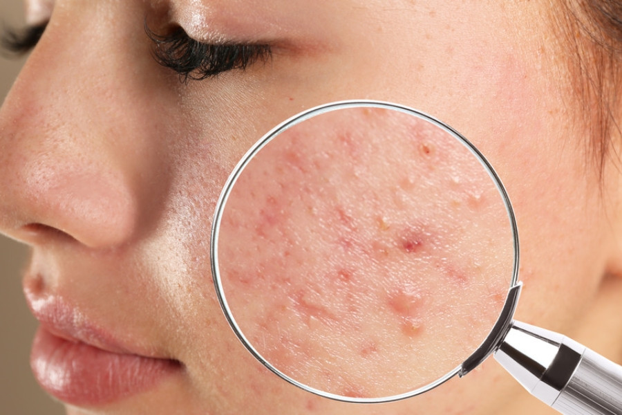 Cách xử lý mụn bọc sưng to an toàn, hạn chế thâm sẹo - Ảnh 2.