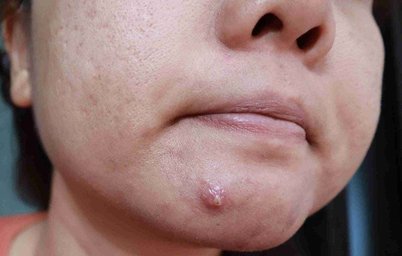 Cách xử lý mụn bọc sưng to an toàn, hạn chế thâm sẹo - Ảnh 3.