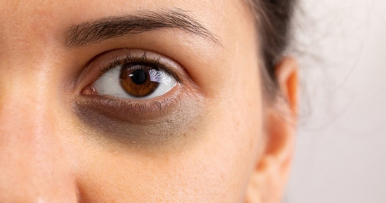 9 loại thực phẩm hỗ trợ sản xuất collagen làm mờ quầng thâm mắt tự nhiên