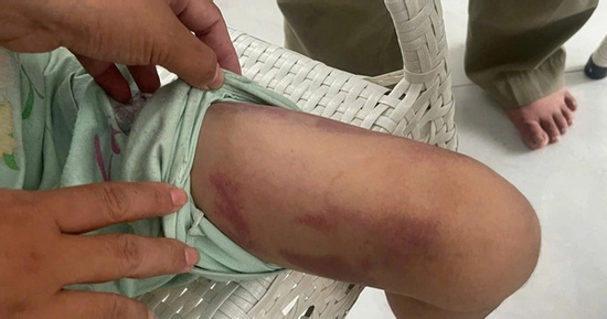 Vụ bé gái 9 tuổi bị bạo hành: Bắt tạm giam mẹ ruột và người tình