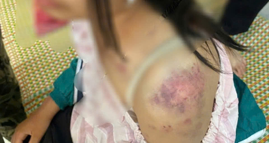 Sức khỏe bé gái bị bà nội và 2 người đàn ông bạo hành đến bầm tím khắp cơ thể