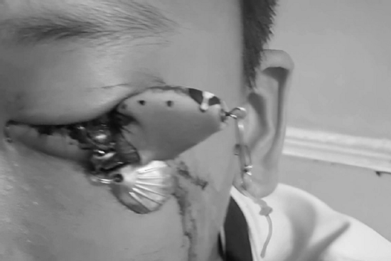 Bé trai 12 tuổi đau mắt dữ dội, bác sĩ gắp ra thứ 