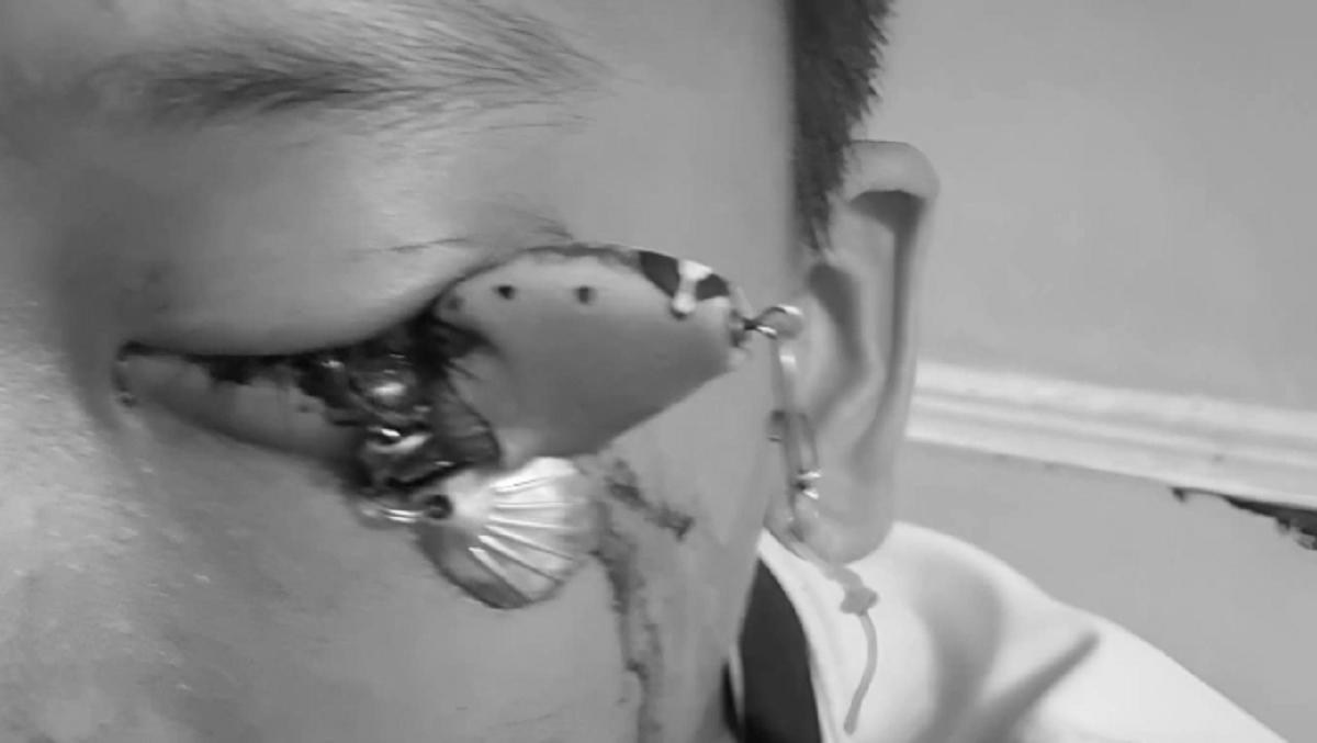 Bé trai 12 tuổi đau mắt dữ dội, bác sĩ gắp ra thứ