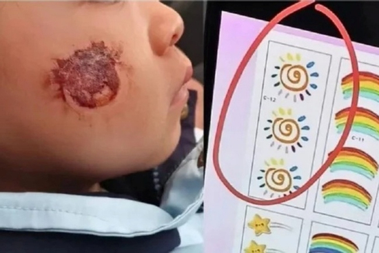 Dán hình lạ theo yêu cầu cô giáo, phụ huynh hoảng hốt khi thấy tình trạng da của con gái
