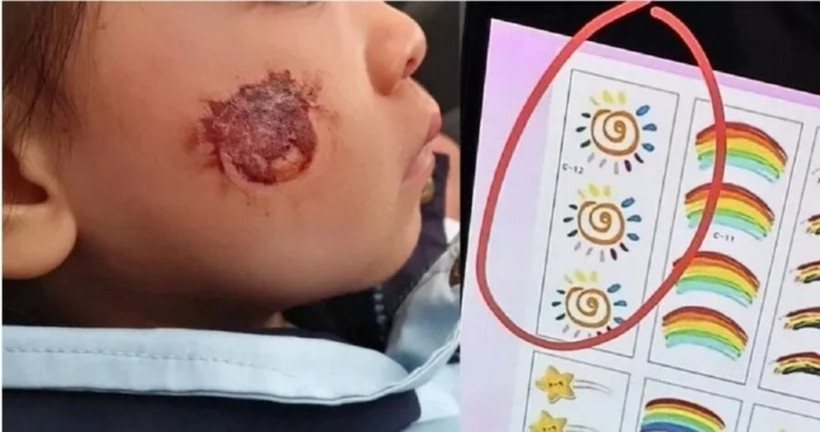 Một bé gái 3 tuổi ở tỉnh Hồ Nam, Trung Quốc, đã bị tổn thương da nghiêm trọng sau khi tham gia hoạt động tại trường mẫu giáo.