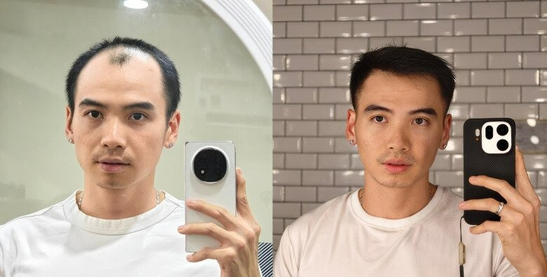 Tình trạng chồng HHen Niê sau nửa năm cấy đầu hói