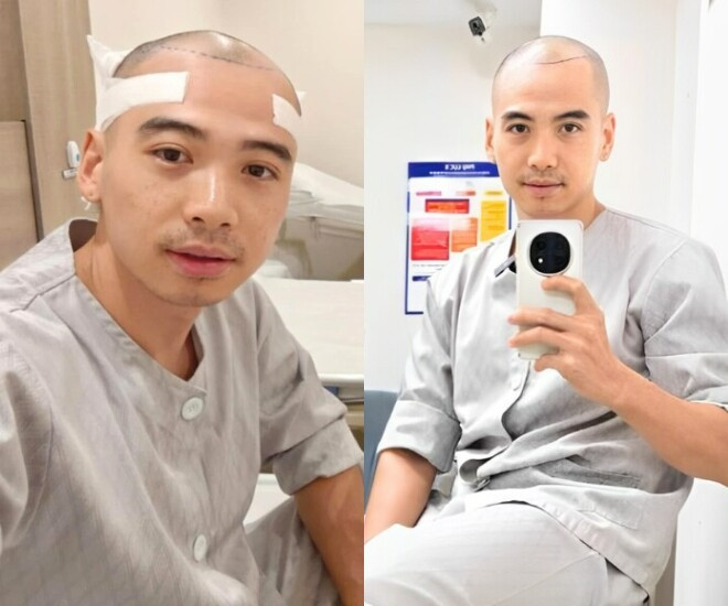 Tình trạng chồng HHen Niê sau nửa năm cấy đầu hói