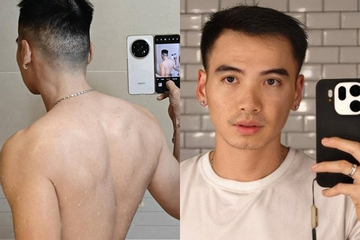 Tình trạng chồng H'Hen Niê sau nửa năm cấy đầu hói