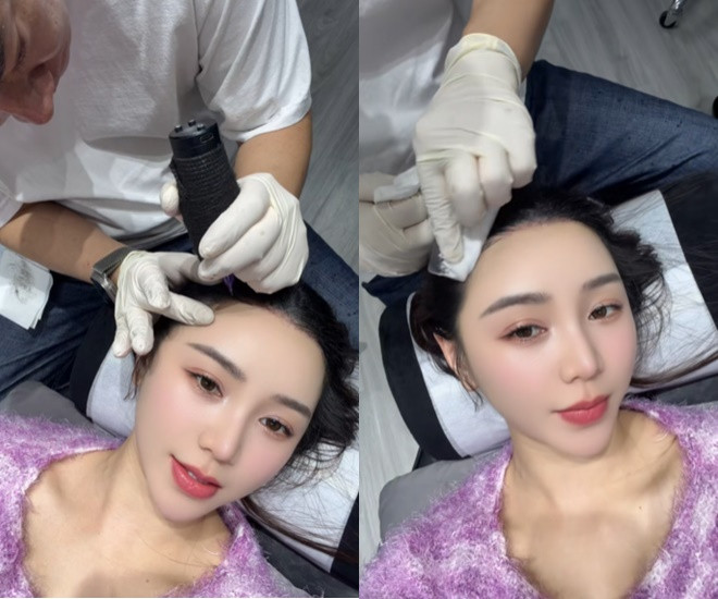Quỳnh Kool công khai can thiệp thẩm mỹ