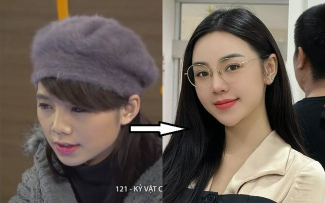 Quỳnh Kool công khai can thiệp thẩm mỹ