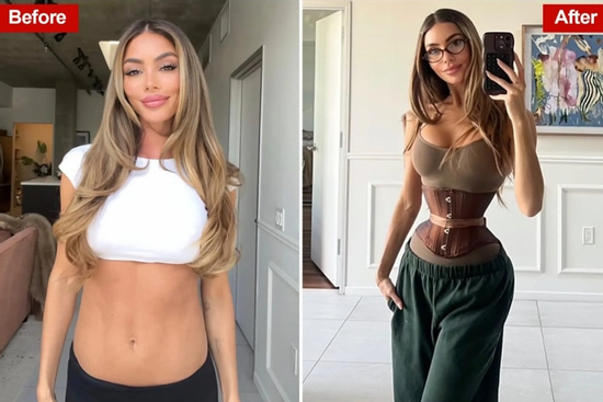 Trào lưu cắt xương sườn để làm đẹp: Ám ảnh vòng eo kiến đẩy phụ nữ vào cuộc chơi nguy hiểm