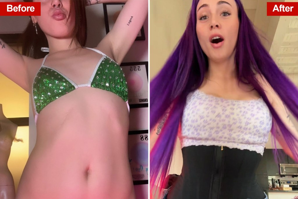 (Left) Emily James before rib removal surgery. (Right) Emily after the surgery.