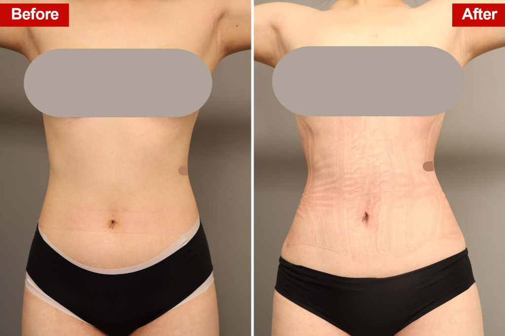 Shiqi Ma before and after rib remodeling surgery.