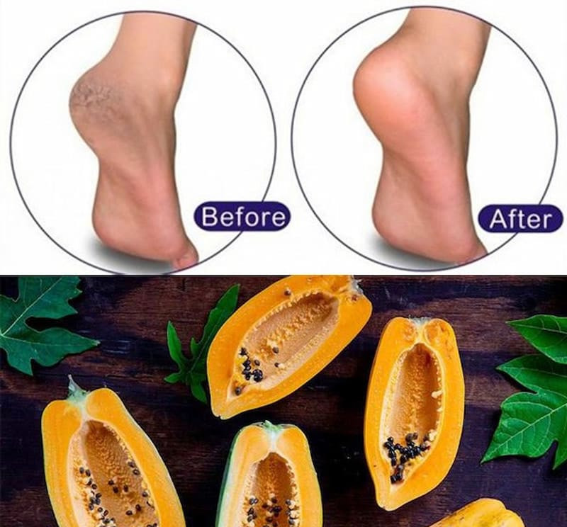 Cách khắc phục tình trạng da gót chân khô, nứt nẻ mùa đông - Ảnh 2.