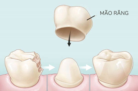 Cách nào hạn chế răng sứ xỉn màu?