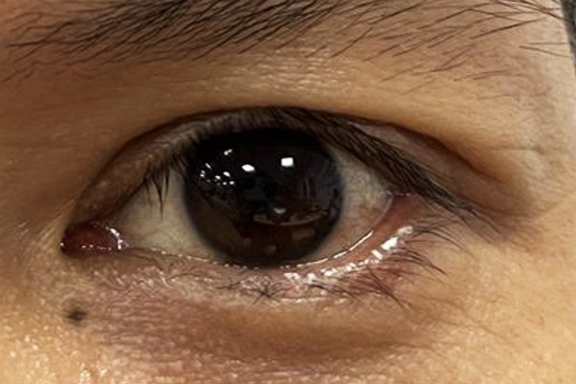 Nốt ruồi dưới mắt của anh L. Ảnh: Báo Dân trí.