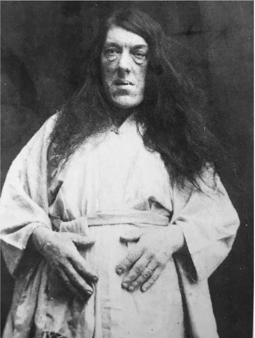 Do căn bệnh quái ác này, bàn tay và bàn chân của bà Bevan phát triển vượt kích thước bình thường. Trán và hàm dưới lồi ra ngoài, còn mũi to ra rõ rệt. Vẻ ngoài thay đổi khiến bà Bevan khó tìm kiếm và giữ được công việc. Ảnh: Historical Photos