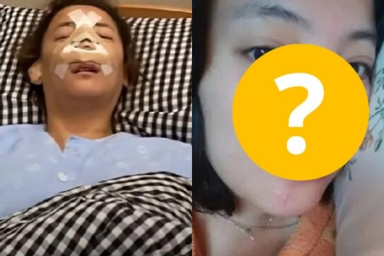 Mất 9 tiếng ròng sửa mũi, nữ diễn viên bị ngã đập mặt xuống sàn gây kinh hãi cả showbiz