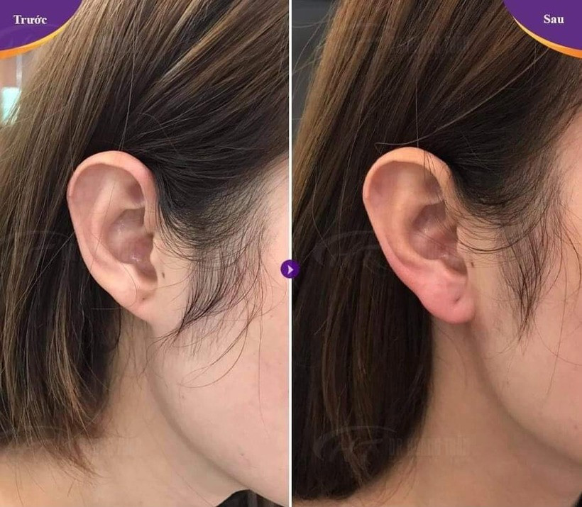 Nếu tiêm quá nhiều filler hoặc tiêm nhầm vào mạch máu, vùng dái tai sẽ căng tức, tắc mạch máu dẫn tới nguy cơ hoại tử. Ảnh minh họa.