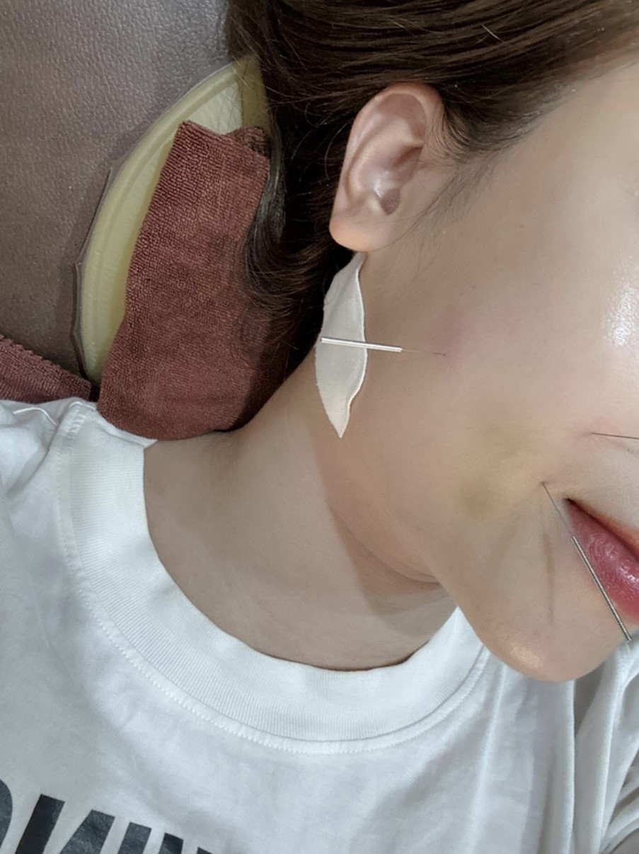 Ca sĩ Dương Hoàng Yến đau đớn khi điều trị châm cứu, sau bị liệt dây thần kinh số 7- Ảnh 2.