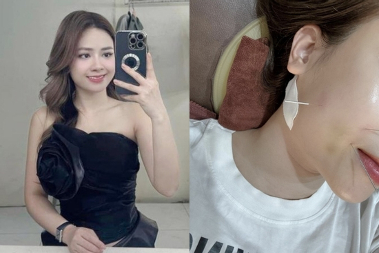 Dương Hoàng Yến đau đớn khi điều trị châm cứu, sau bị liệt dây thần kinh số 7