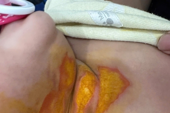 Hà Nội: Trẻ 9 tháng tuổi bị bỏng tại cơ sở mầm non