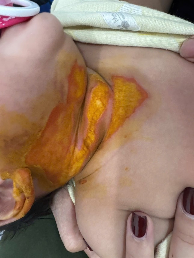 Hà Nội: Trẻ 9 tháng tuổi bị bỏng tại cơ sở mầm non, chủ trường nói: 'Sự việc rất nhỏ' ảnh 1