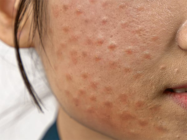 Tiêm meso có an toàn không?- Ảnh 2.