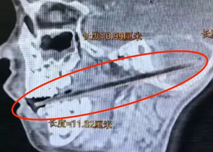 Hình chụp X-quang cho thấy cây kẹo que đâm vào não của cậu bé. (Ảnh: Jam Press )