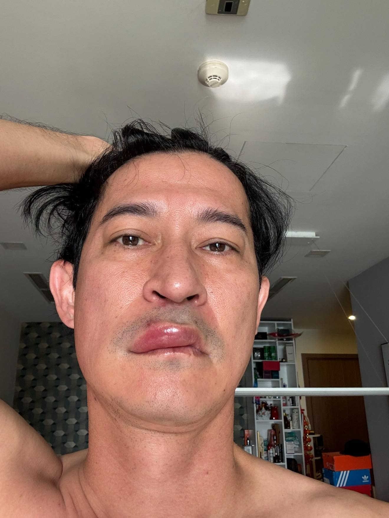 Giật mình hỉnh ảnh diễn viên Huy hánh với gương mặt biến dạng sưng phù