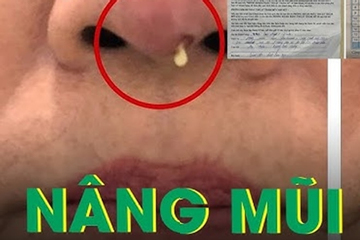 Nâng mũi 10 triệu bị 'thổi giá’ lên 205 triệu nhận cái kết mũi sưng đỏ, cứng như đá