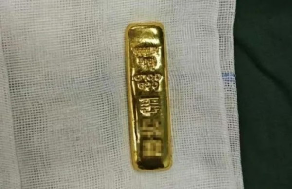 Trung Quốc: Bé trai thấy bụng bị sưng, hóa ra bé đã nuốt một thỏi vàng lớn ảnh 2