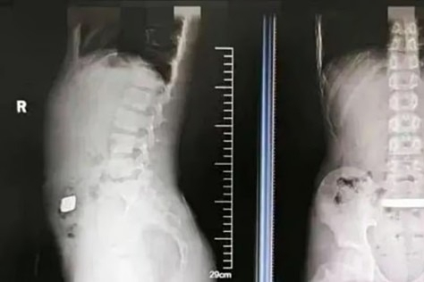 Trung Quốc: Bé trai thấy bụng bị sưng, hóa ra bé đã nuốt một thỏi vàng lớn