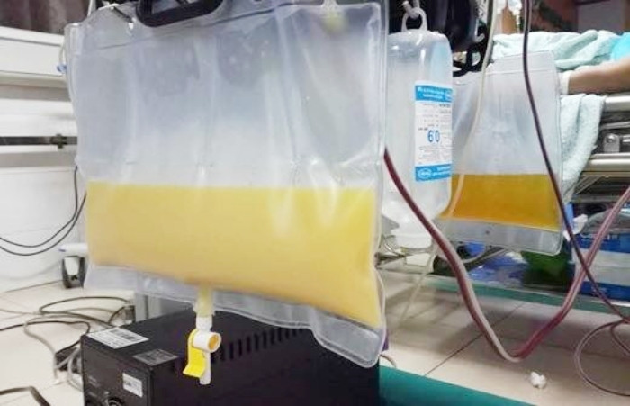 Được chẩn đoán viêm tụy cấp, huyết tương người đàn ông đục như nước gạo. (Ảnh: BSCC)