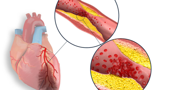 Cách phòng ngừa bệnh nhồi máu cơ tim cấp hiệu quả, người Việt tuyệt đối không bỏ qua