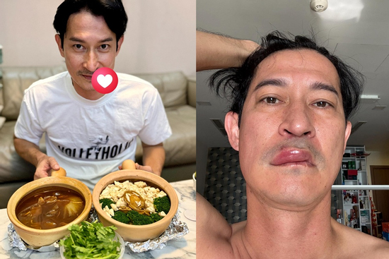 Huy Khánh hiện ra sao sau hình ảnh môi sưng phù, mặt biến dạng