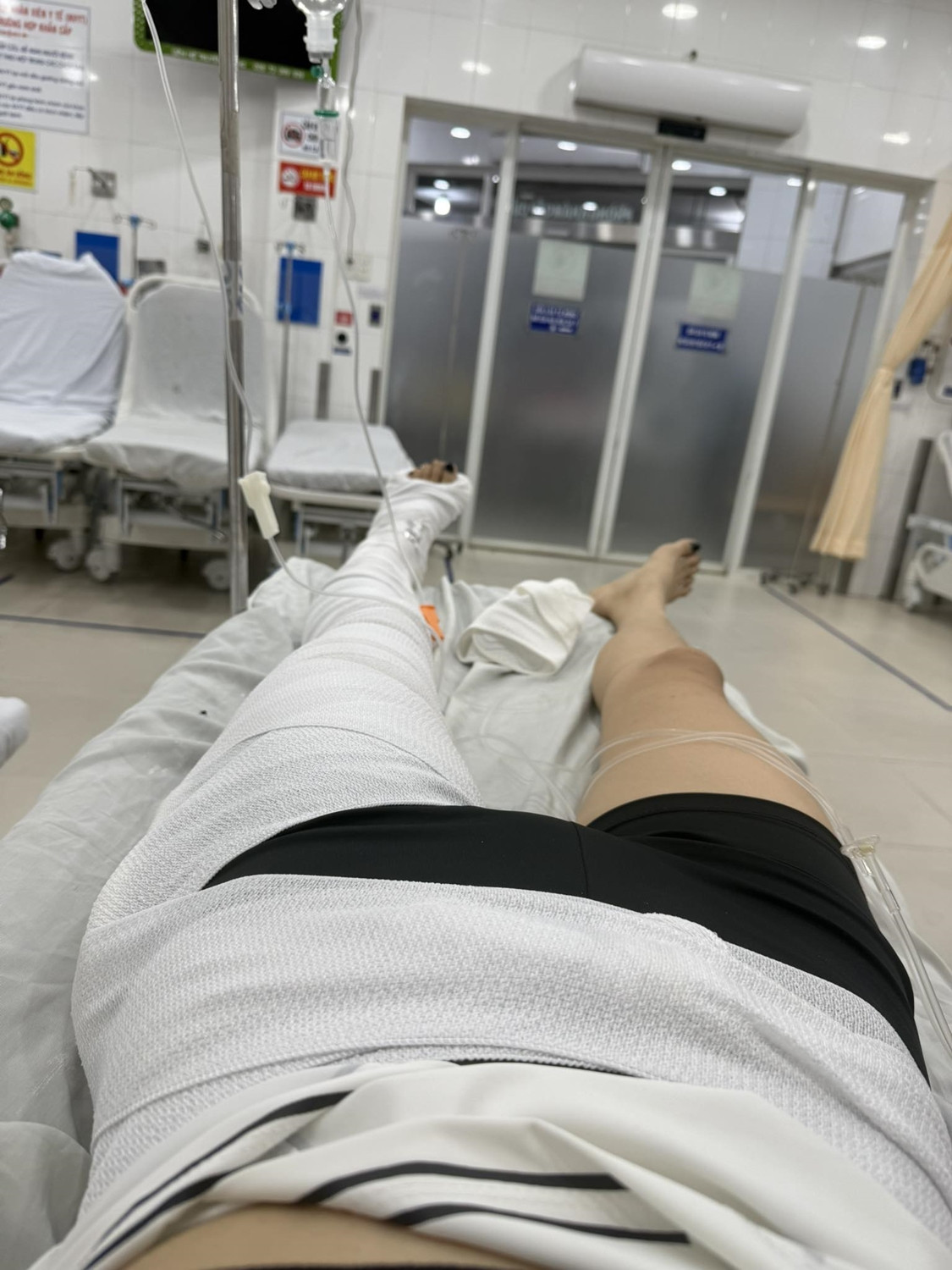 Vợ Mạc Hồng Quân gãy xương đùi bó bột đến mức nhìn thôi cũng thấy quá đau