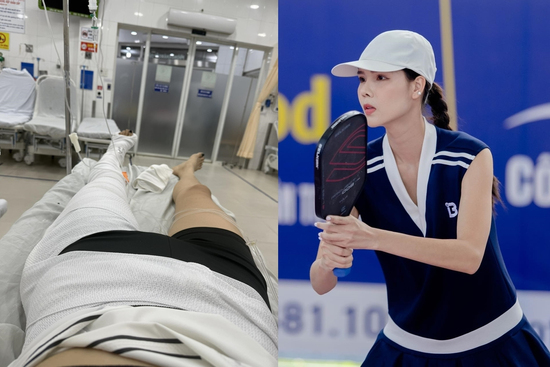 Vợ Mạc Hồng Quân gãy xương đùi, bó bột đến mức nhìn thôi cũng thấy đau
