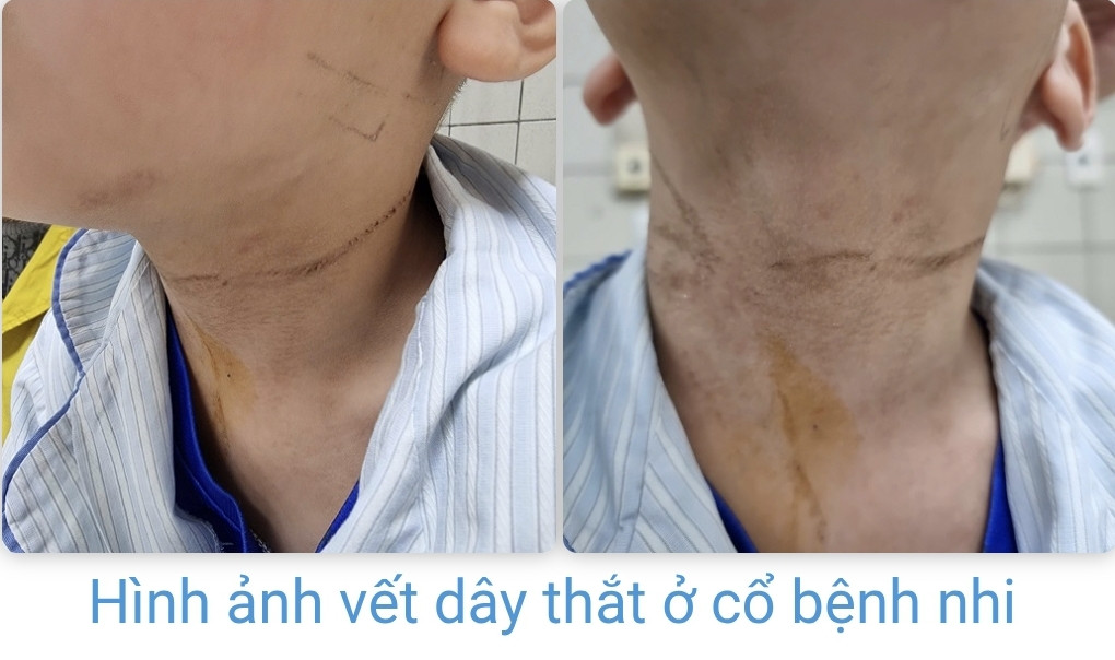 Hi hữu bé trai 5 tuổi nghịch dây giải rút, tự 'thắt cổ' mình- Ảnh 2.