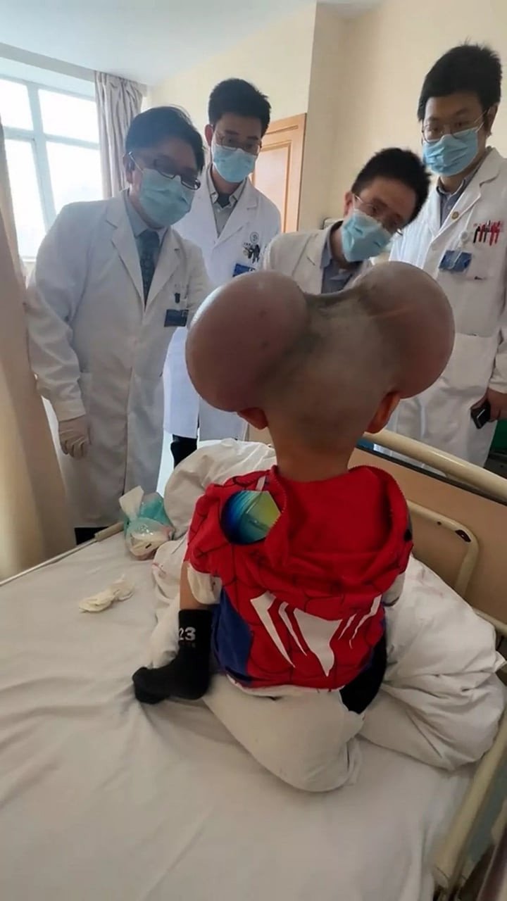 Tình trạng của Qibao chủ yếu là do sự phát triển quá mức của các tế bào sản xuất sắc tố trong da. (Ảnh: NX)